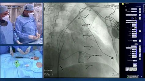 Percutaneous Tricuspid Valve Replacement How To Perform It Session