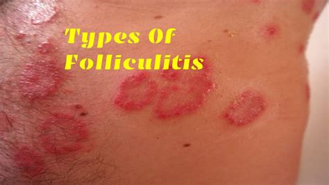 Folliculitis Types