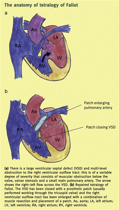Essentials Of Paediatric Cardiac Surgery Surgery Oxford