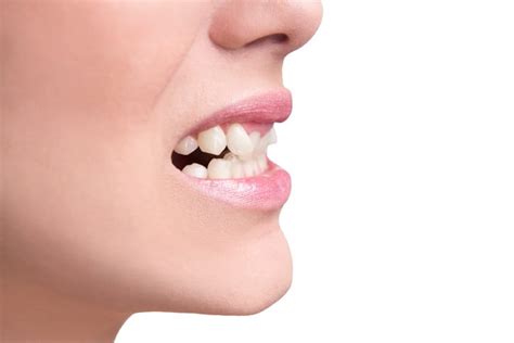 Although sometimes it can give you the cost for orthodontic treatment to fix crooked teeth can vary. How to Fix Crooked Teeth | La Mesa Dental Center | La Mesa ...