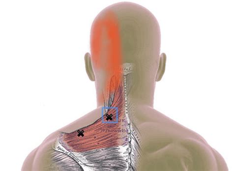 Trigger Points For Migraines And Headaches Life After Pain