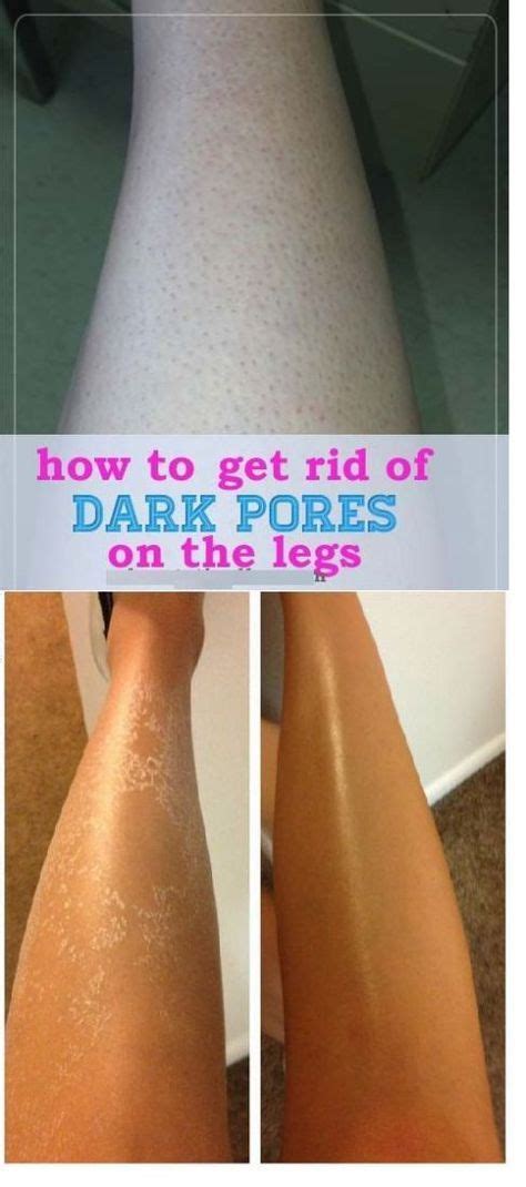 Find deals on products in skin care on amazon. How To Get Rid Of Dark Pores On Legs | Dark pores, Skin ...