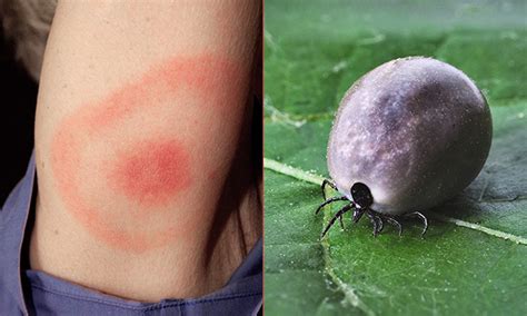 Woman Catches Lyme Disease From Tick Bite At Clissold Park Say