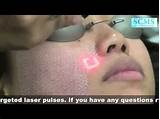 South Korean Acne Scar Treatment Photos