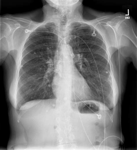 Pa Chest X Ray Technique