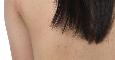 Are Red Spots On The Skin A Gluten Allergy Livestrongcom