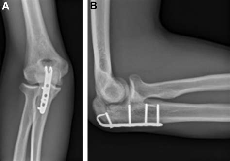 Surgical Treatment Of Displaced Olecranon Fracture Through A Persistent