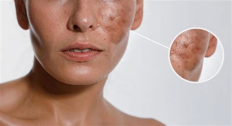 What Causes Hyperpigmentation Daphne Panagotacos Md Inc Dermatology