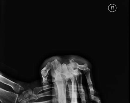 Hamate Fracture Classification Radiology Reference Article Radiopaedia Org