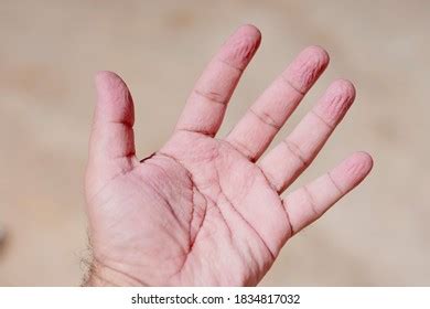 Man Shocked Wrinkly Pruney Skin His Foto Stock Shutterstock