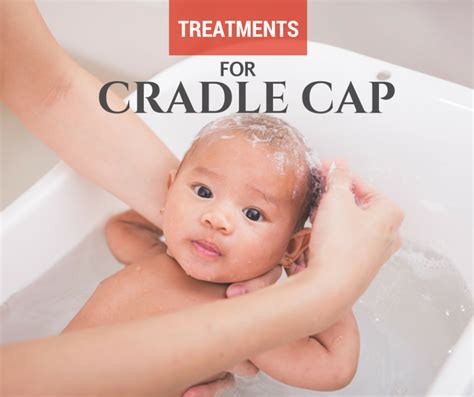 Treatments For Cradle Cap Day Care Quincy Ma A Childs View Centers