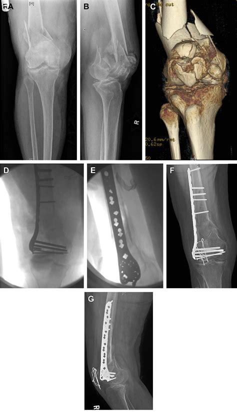 Management Of Distal Femur Fractures In Adults An Overview Of Options My Xxx Hot Girl