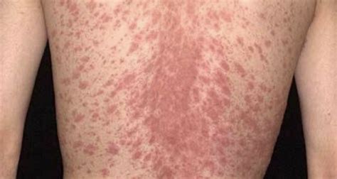 Understanding Skin Conditions Pityriasis Rosea Vs Tinea Versicolor