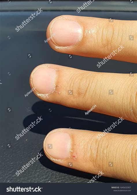 Paronychia Swollen Finger Fingernail Bed Inflammation Stock Photo Edit