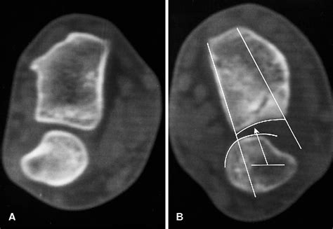 Distal Radioulnar Joint Dislocation