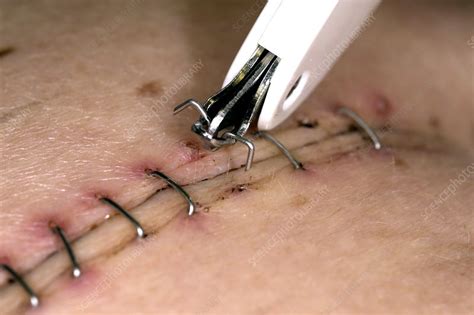 Oesophagectomy Suture Removal Stock Image C0199659 Science Photo