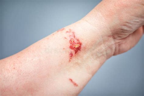 Skin Burn Injury Sun Radiation Stock Image Image Of Epidermic Health