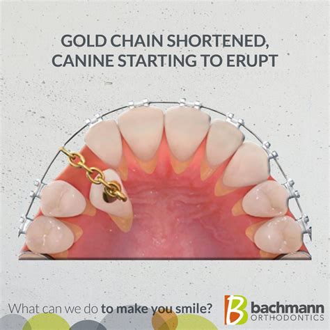 Impacted Canines What Can We Do To Make You Smile