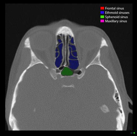 Frontal Sinus Radiology Reference Article Radiopaedia Org