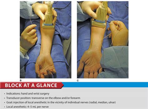 Ultrasound Guided Forearm Blocks Anesthesia Key