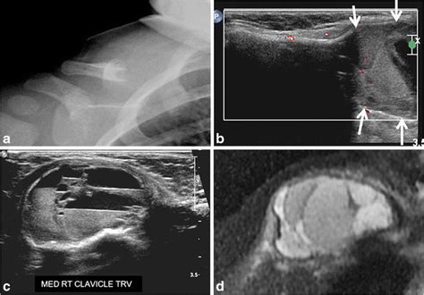 Aneurysmal Bone Cyst In A 15 Month Old Boy With Enlarging Hard Immobile