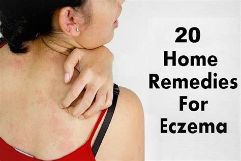 20 Best Natural Home Remedies For Eczema In Adults