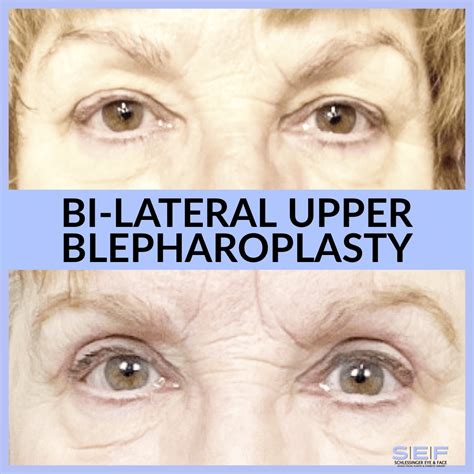 Ptosis Before And After Gallery Schlessinger Eye And Face Woodbury Ny