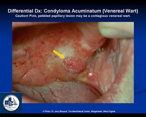 Searchable database of papilloma genomes with visualization and analysis tools. Condyloma acuminatum
