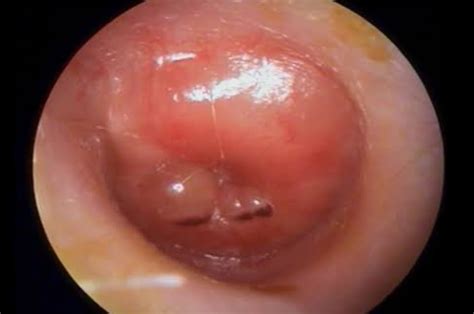 What Does An Ear Infection Look Like In An Otoscope Quora