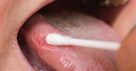 Effective Ways To Treat Tongue Sores From Vaping Naturally
