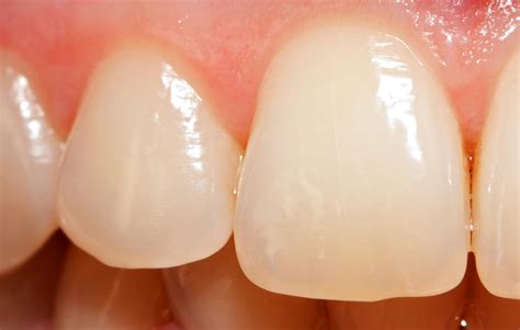 Effect Of Enamel And Tooth Surface Wear On Patients Quality Of Life