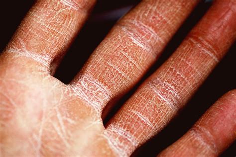 Can Acupuncture Treat Eczema