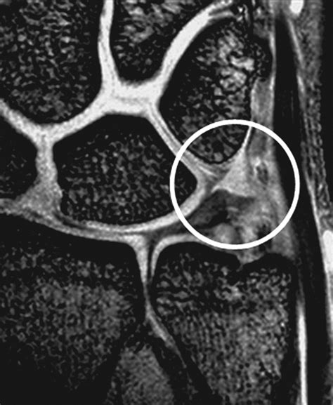 Pitfalls That May Mimic Injuries Of The Triangular Fibrocartilage And