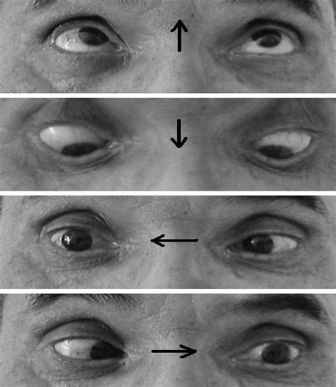 Cranial Nerve Palsies Smarty Pance Cranial Nerves Nerve Palsy Porn Sex Picture