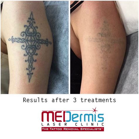 They are done in an office with trained personnel and typically take several sessions spaced 7 weeks. Laser Tattoo Removal After 6 Sessions - Tattoo Ideas