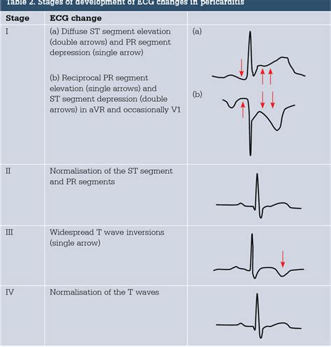 Satges Of ECG Changes In Pericarditis MEDizzy