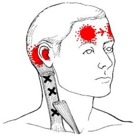 Sternocleidomastoid Trigger Points And Referred Pain Patterns
