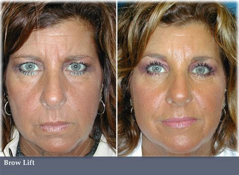 Brow Lift Vargas Face And Skin Center