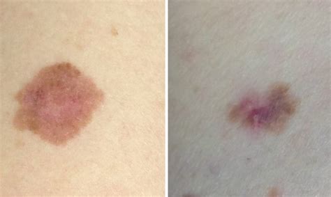 This Is What Melanoma Skin Cancer Looks Like Huffpost Uk Life