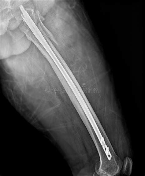 X Ray Femur Bone Fracture After Total Hip Replacement Stock Photo