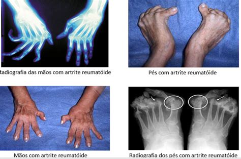 Farma Informa Conhecendo A Artrite ReumatÓide