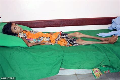 Twelve Year Old Girl Weighs Just 22lbs As Yemen S War Drives People To The