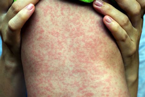 Phe Advises Measles Mumps And Rubella Checks Following Measles