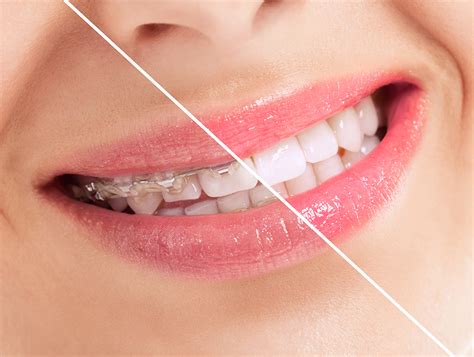 Profile Orthodonticsthe Ultimate Suresmile Braces Before And After