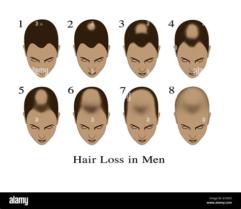 Illustration Showing The Stages Of Hair Loss In Men With Pattern Stock