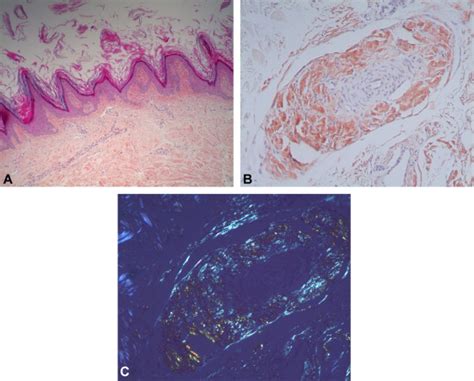 Simultaneous Occurrence Of Insulin Derived Amyloidosis And Acanthosis
