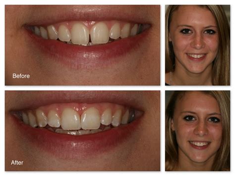How do i care for my new front teeth? Closing Gaps Gallery - Dr. Jack M. Hosner, D.D.S.