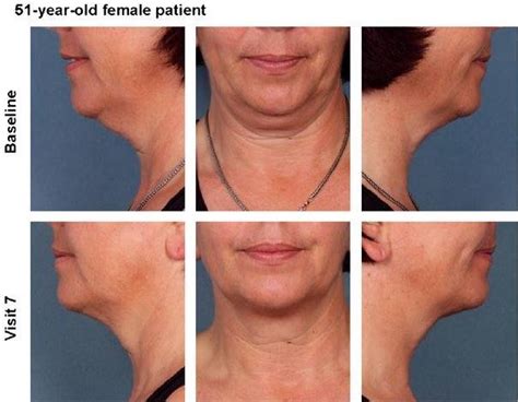 Before And After Pictures Of Kybella™ In Charlotte Nc Darst