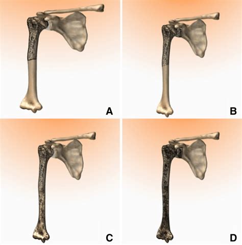 Types Of Humeral Resection A Type Iintraarticular Proximal Humerus