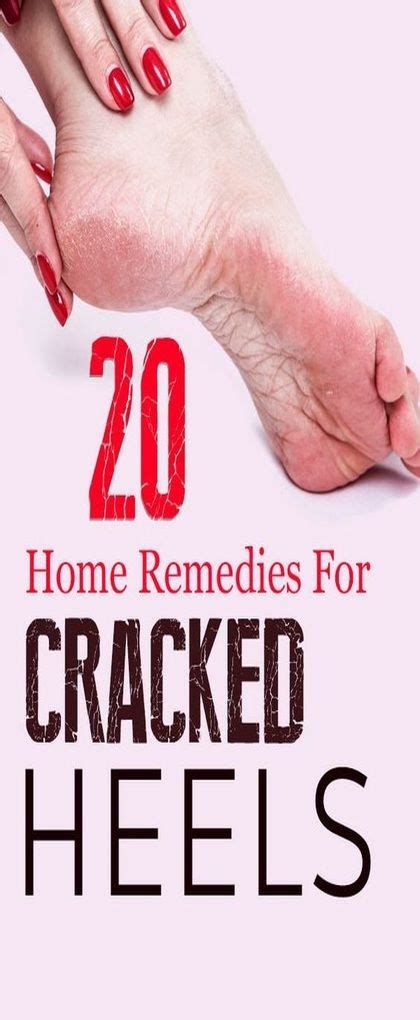 20 Home Remedies For Cracked Heels Causes And Prevention Tips Wellness Magazine